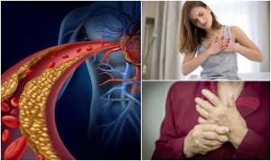 De 10 kjennetegnene på høyt kolesterol