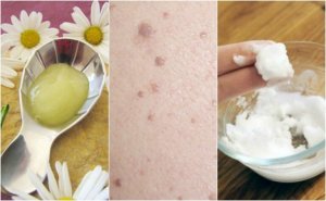 Fem behandlinger for å bli kvitt flate vorter