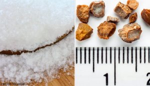 7 hjemmelagde midler for å bli kvitt nyrestein