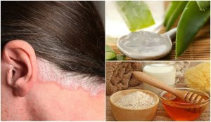 5 hjemmebehandlinger mot psoriasis i hodebunnen