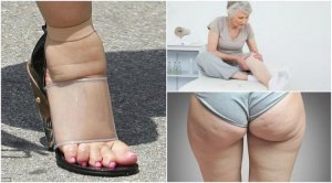 5 vanlige symptomer på væskeansamling