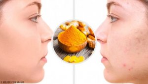 5 gurkemeiemasker som fjerner aknearr