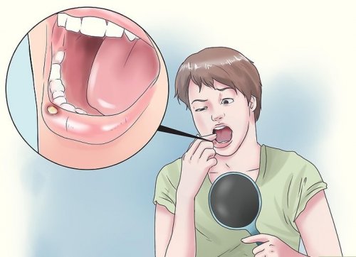 8 naturlige remedier mot munnsår