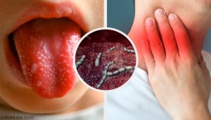 Skarlagensfeber: Årsaker, symptomer og behandling