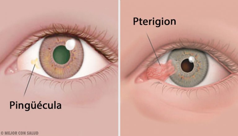 Svulster på øyet: pinguecula og pterygium