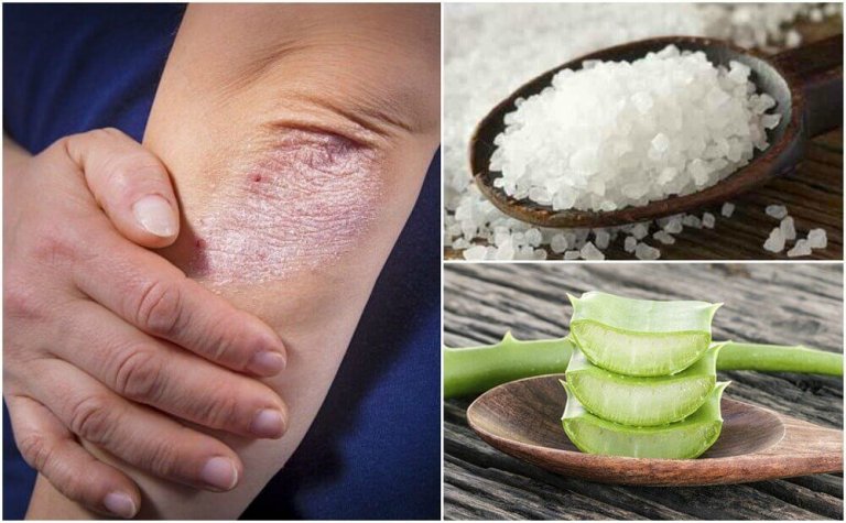 Bekjemp sopp i huden med disse 5 naturlige løsningene