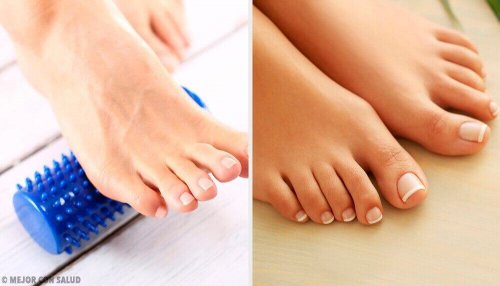 Bli kvitt hallux valgus med øvelser