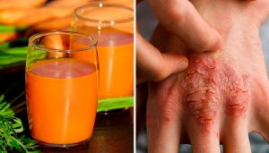 Bekjemp og unngå psoriasis med disse 7 naturlige midlene