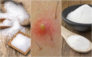 5 naturlige løsninger for inngrodde hår