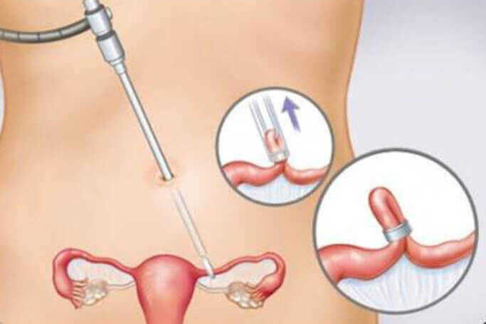 permanente prevensjonsmetoder