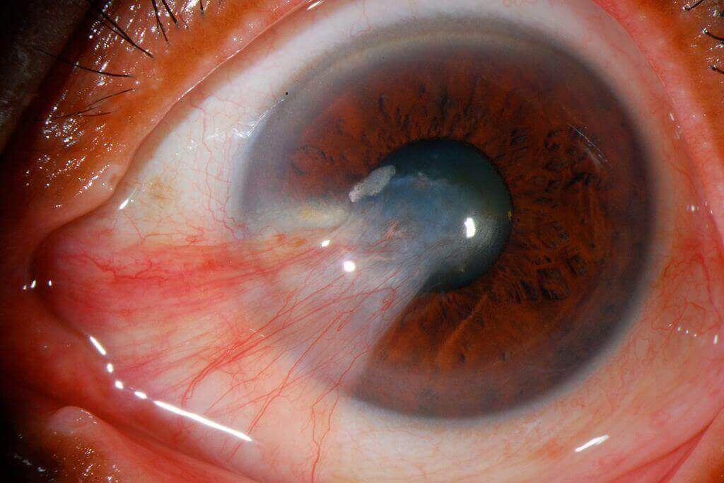 Pterygium