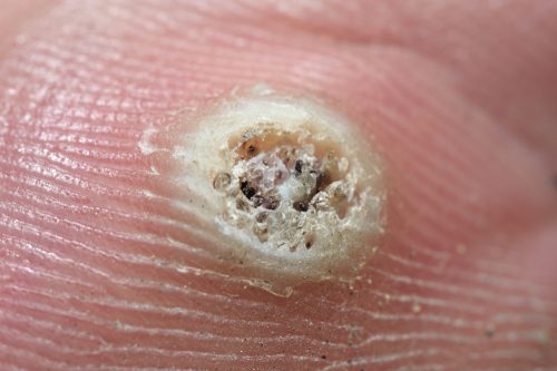 Vorter ved Humant Papillomavirus