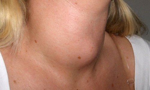 Tegn på strupekreft: hevelse i halsen