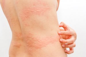 Råd for å lindre elveblest med 3 naturlige midler