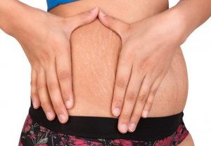 To naturlige alternativer for å behandle strekkmerker