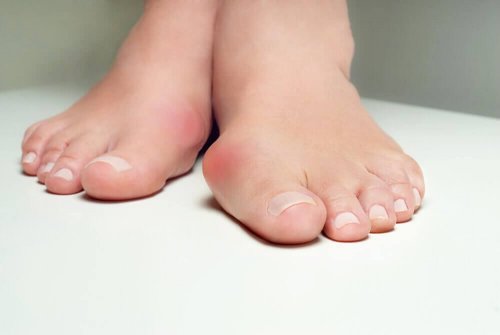 5 urter som hjelper deg med å bekjempe hallux valgus