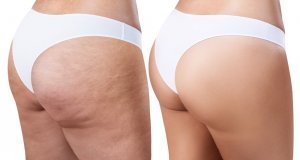 Lær hvordan du kan eliminere cellulitter med effektive og enkle hjemmelagde midler