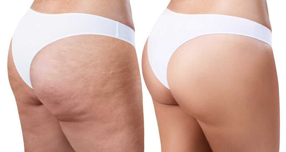 Lær hvordan du kan eliminere cellulitter med effektive og enkle hjemmelagde midler Lær hvordan du kan eliminere cellulitter med effektive og enkle hjemmelagde midler