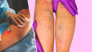 Hvordan kan man behandle åreknuter?