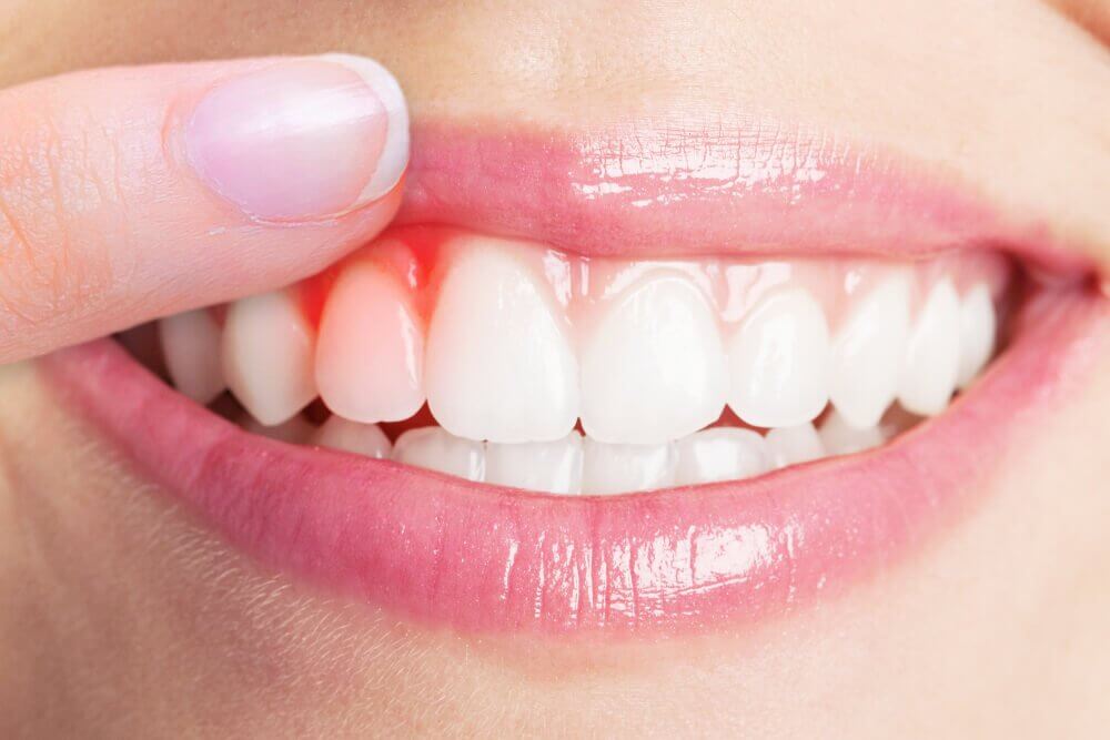 De 5 beste midlene for å lindre tannkjøttbetennelse