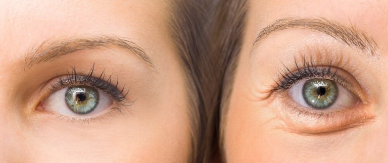 Motvirk hengende øyelokk med 5 naturlige ingredienser