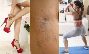 10 tips for å hjelpe deg med å unngå åreknuter