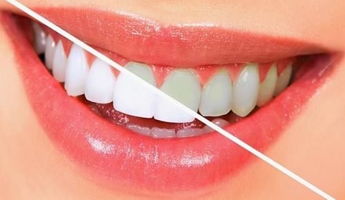 10 matvarer som bidrar til å bleke tennene dine naturlig