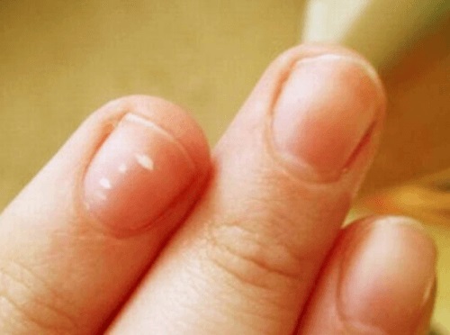 Hva forteller lunulaen på neglene dine om helsa di?