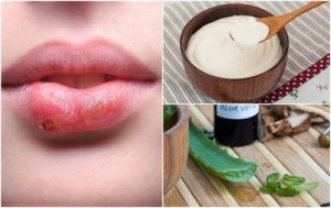 7 effektive naturlige måter å behandle forkjølelsessår på