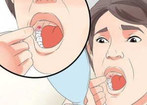 Tips for å redusere hevelse når visdomstennene er fjernet