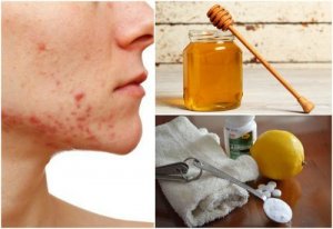 6 naturlige behandlinger mot cystisk akne