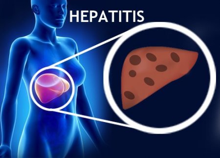 Hepatitt