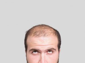 Tre naturlige remedier for å unngå skallethet
