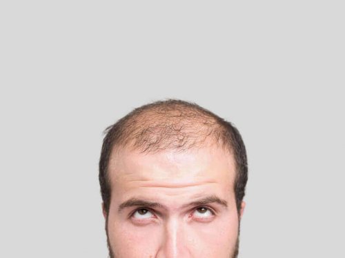 Tre naturlige remedier for å unngå skallethet