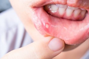 7 naturlige midler for å behandle munnskold