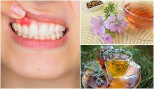 5 naturlige midler for å bekjempe gingivitt
