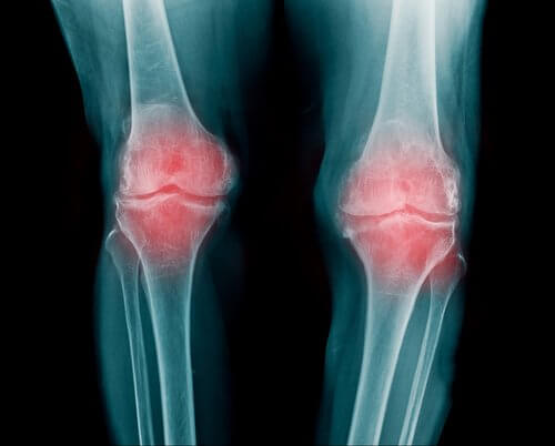Osteoartritt