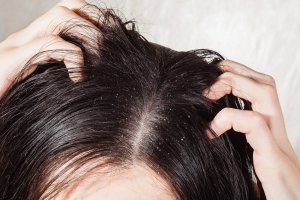 6 naturlige midler for sopp i hodebunnen