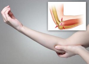 5 naturlige remedier for å lindre din tennisalbue