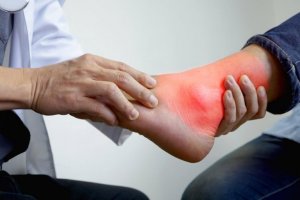 De beste naturlige remediene mot betennelser