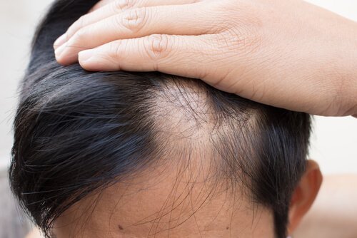 bekjempe alopecia