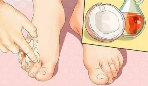 Fire råd for å bli kvitt hallux valgus og liktorn