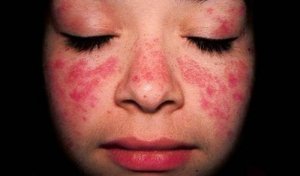 Lær om behandlingen for Systemisk lupus erythematosus