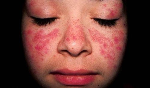 Lær om behandlingen for Systemisk lupus erythematosus