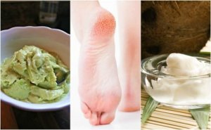 Prøv disse 5 hjemmeremediene for sprukne hæler