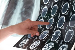 6 tips for å hjelpe deg med å forhindre hjerneslag