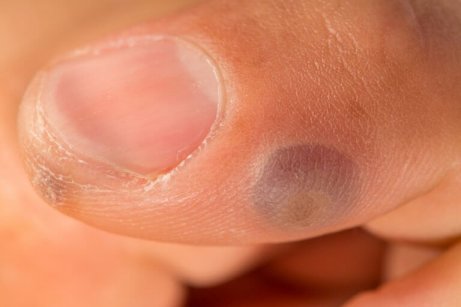 vorte på finger vorte på finger