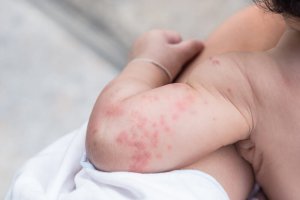 Varmeutslett hos babyer: Bør jeg være bekymret?