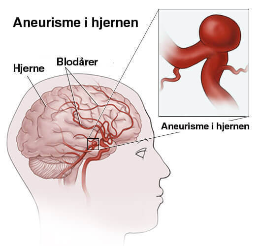 Hva er aneurisme i hjernen?