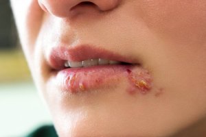 Herpes hos barn: Årsaker, symptomer og behandling